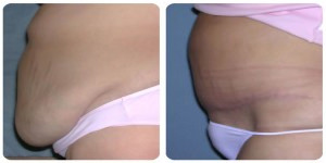 Tummy Tuck before and after in London by LBPS